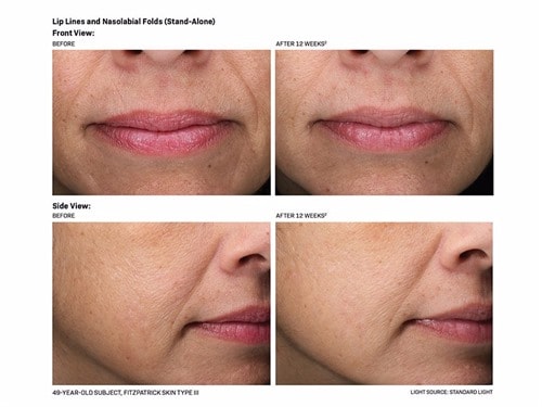 Revision Skincare Revox Line Relaxer Serum with Peptides & Hyaluronic Acid
