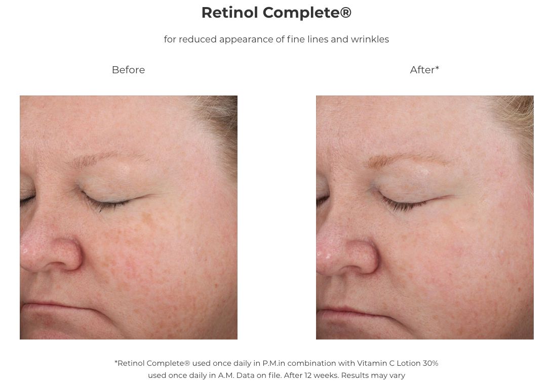Revision Skincare Retinol Complete® 1.0 (1 oz) - Anti-Aging Facial Serum