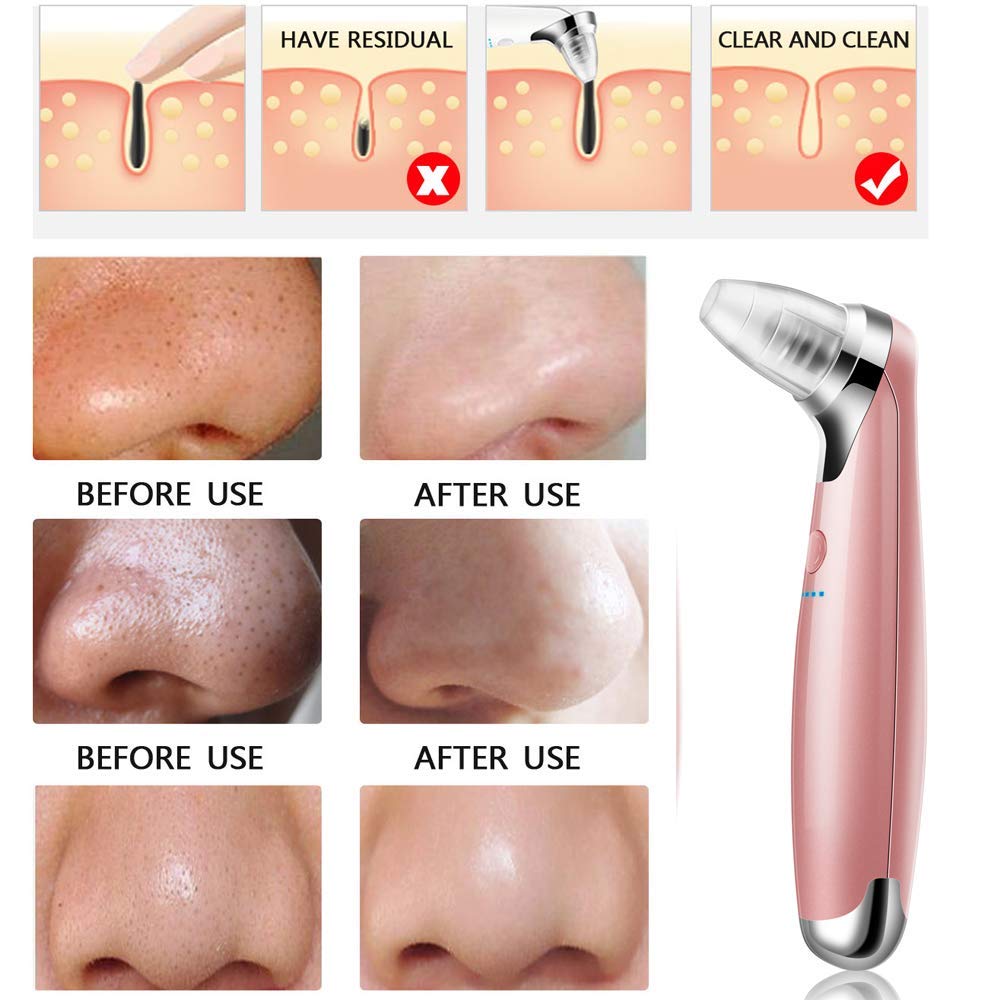 Electric Blackhead Remover Vacuum with 5-Speed Adjustment and 5 Suction Heads for Facial Skin Care (Pink)