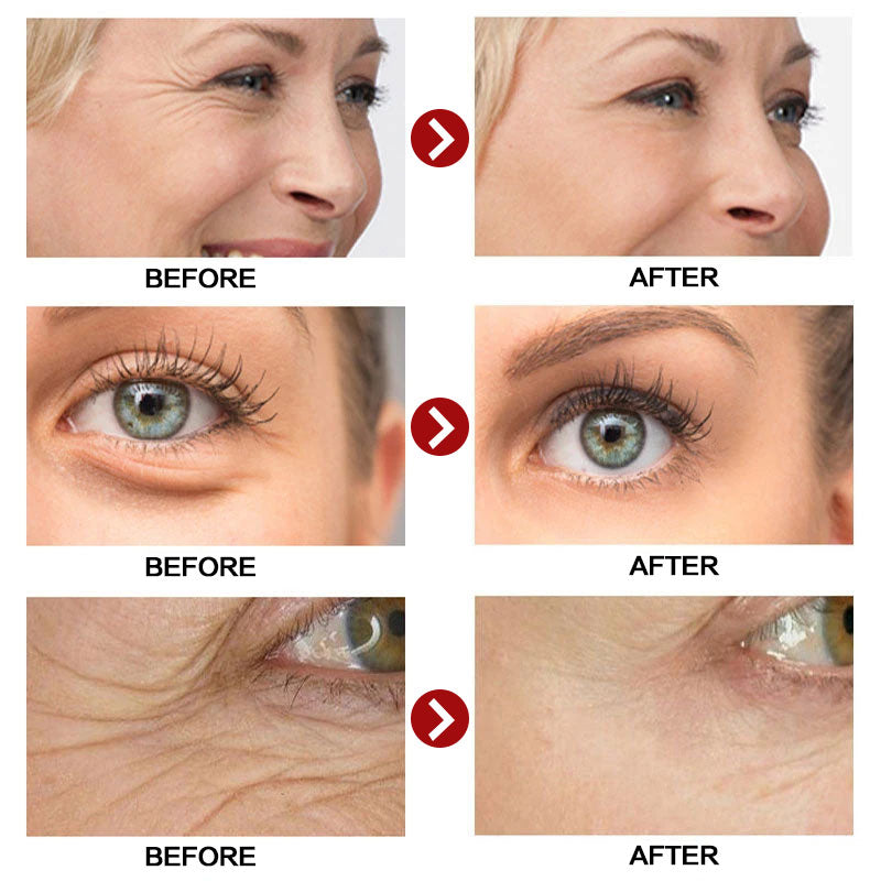 LANBENA Retinol Face Serum - Anti-Aging, Acne Scar Removal & Skin Brightening