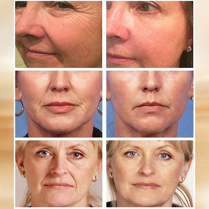 LANBENA Retinol Face Serum - Anti-Aging, Acne Scar Removal & Skin Brightening