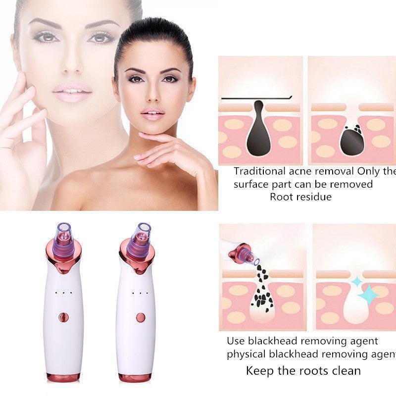 Blackhead Remover Vacuum Suction Tool for Acne & Pore Cleaning