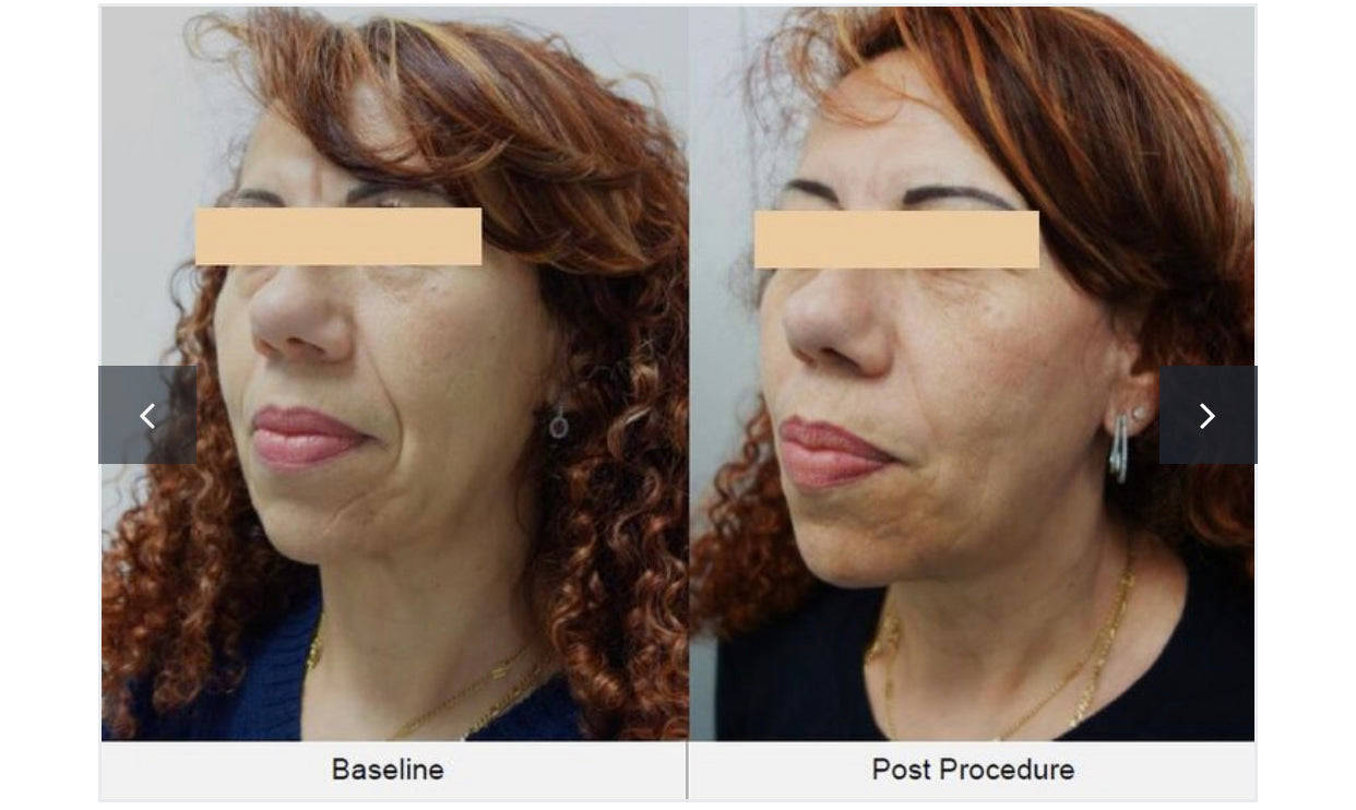 Th4 HIFU SONO MTS Facial Rejuvenation Hydration Skincare System