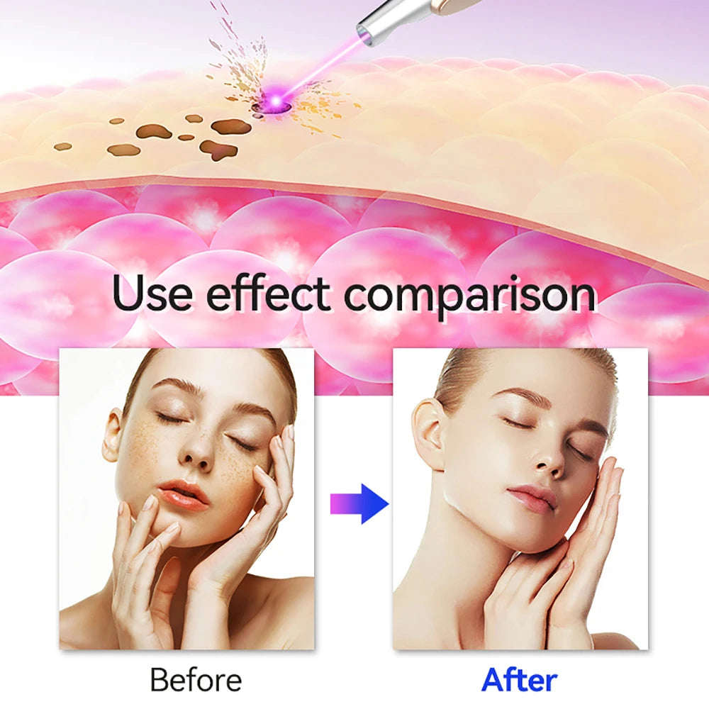 LESCOLTON LS-831/LS-830 Facial Skin Care Tools for Moles, Tattoos, Blackheads, and Skin Tags Removal