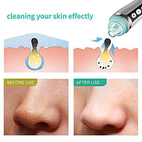 Advanced Electric Blackhead Remover with Vacuum Suction for Deep Pore Cleansing