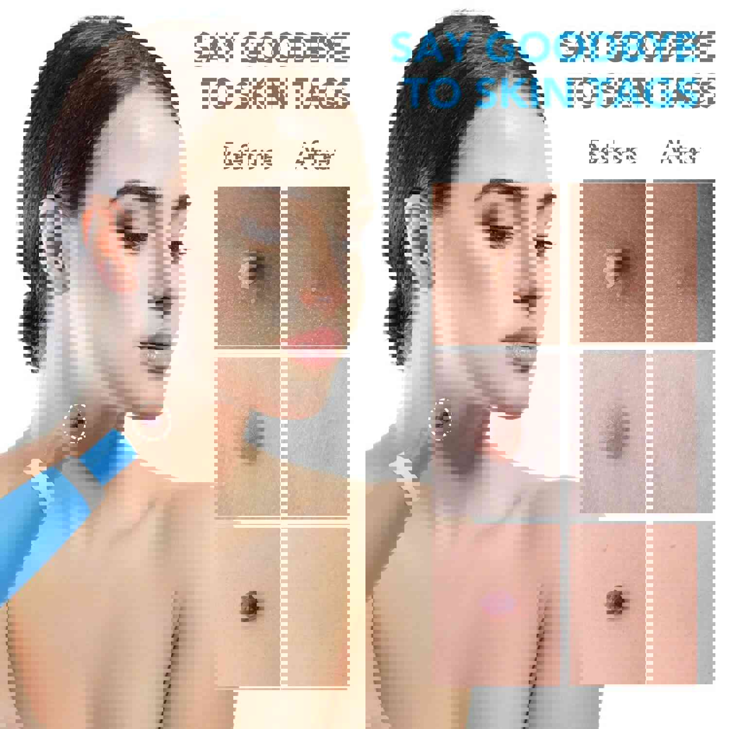 Dual-Function Automatic Skin Tag & Mole Remover Kit